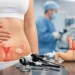 Best Bariatric Procedure for PCOS