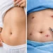 Scarless Gastric Sleeve vs Standard Sleeve