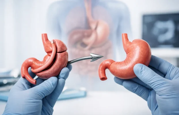 Can Gastric Bypass Be Revised?